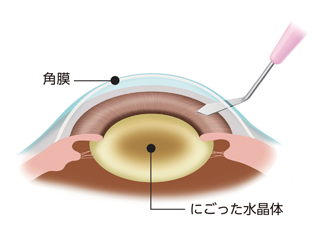 切開します