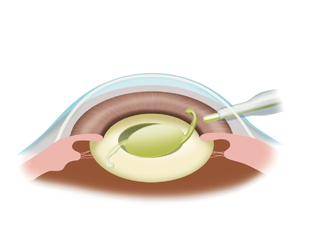 眼内レンズを挿入します